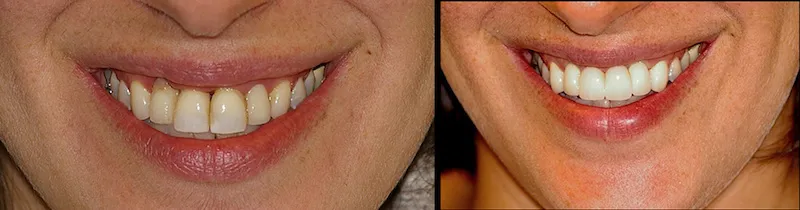 Before and After Dental Treatment in Bergen County NJ