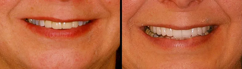 Before and After Dental Treatment in Bergen County NJ