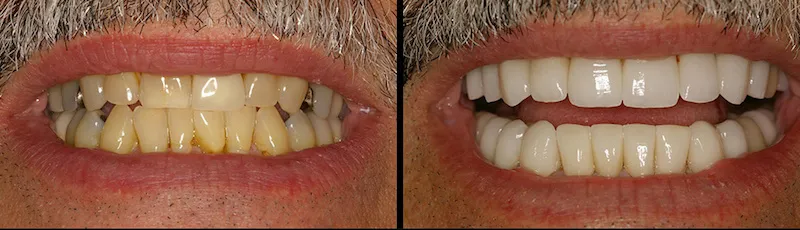 Before and After Dental Treatment in Waldwick, NJ