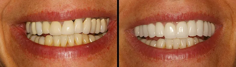 Before and After Dental Treatment in Waldwick, NJ