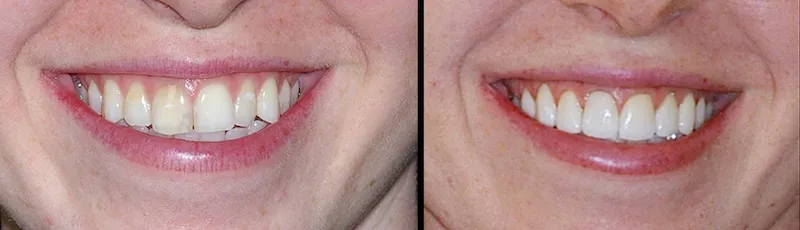 Before and After Dental Treatment in Waldwick, NJ
