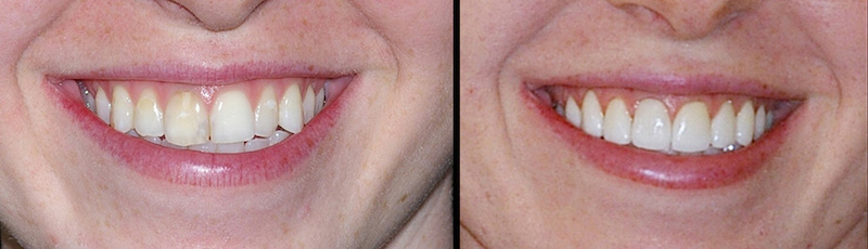 Before and After Dental Treatment in Waldwick, NJ