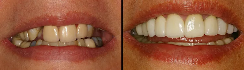 Before and After Dental Treatment in Waldwick, NJ