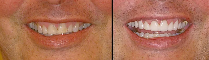 Before and After Dental Treatment in Bergen County NJ