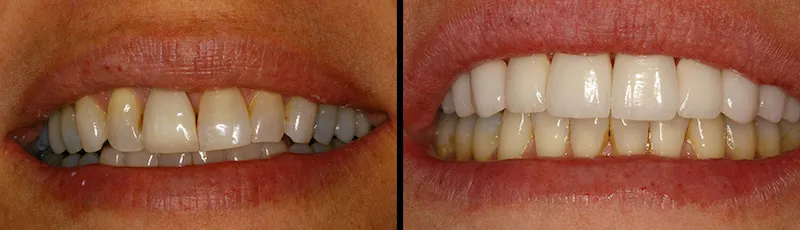 Before and After Dental Treatment in Waldwick, NJ