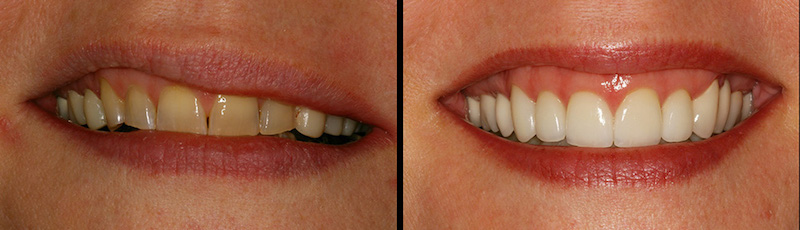 Before and After Dental Treatment in Waldwick, NJ