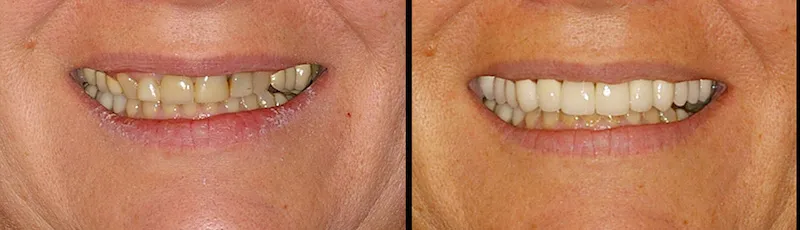 Before and After Dental Treatment in Waldwick, NJ