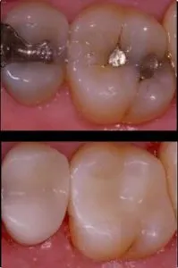 Before and After CEREC Same-Day Crowns in Bergen County NJ