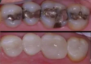Before and After CEREC Same-Day Crowns in Bergen County NJ