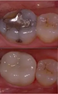 Before and After CEREC Same-Day Crowns in Bergen County NJ