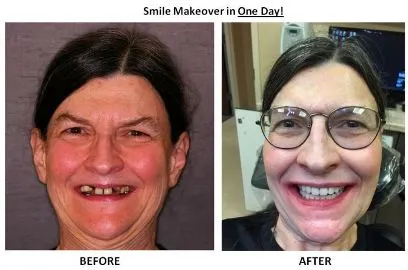 dental implants before and after bergen county