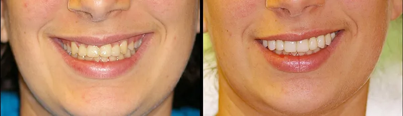 Before and After Teeth Veneers in Bergen County NJ