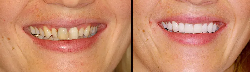 Before and After Teeth Veneers in Bergen County NJ