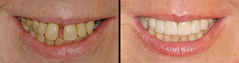 Before and After Teeth Photos showing Teeth Veneers in Bergen County NJ