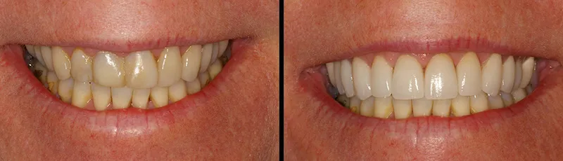 Before and After Dental Treatment in Waldwick, NJ