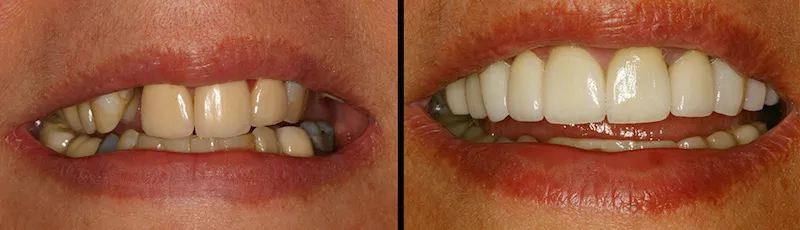 Before and After Dental Treatment in Bergen County NJ