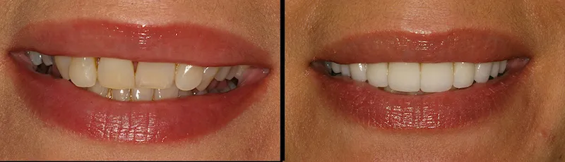 Before and After Dental Treatment in Bergen County NJ