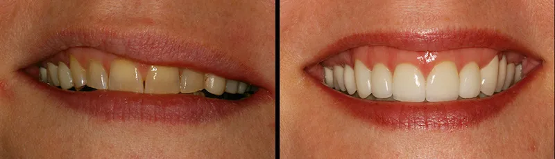 Before and After Dental Treatment in Bergen County NJ