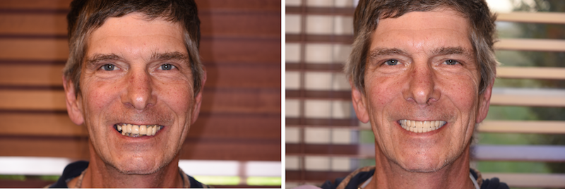 Before and After Permanent Dentures by Bergen County, NJ Dentists