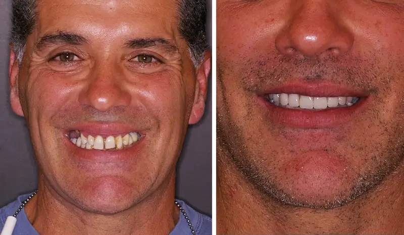 Before and After All-on-4 Dental Implants in Bergen County, NJ